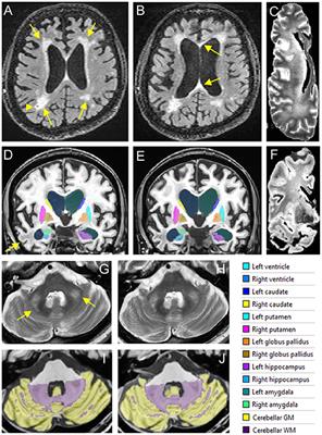 Case Report: Coexistence of Alzheimer-Type Neuropathology in Fragile X-Associated Tremor Ataxia Syndrome